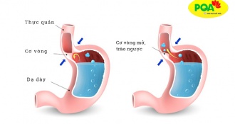 Mối liên quan giữa bệnh hen suyễn và trào ngược dạ dày thực quản